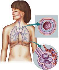 Emphysema diagram