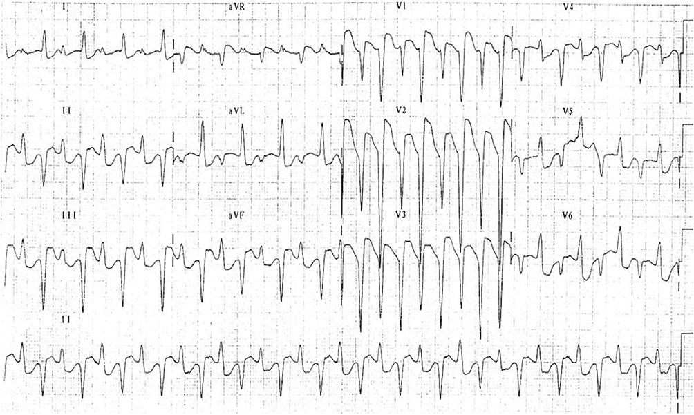 Ventricular fibrillation is an abnormal heart rhythm in which the ventricles of the heart quiver. It is due to disorganized electrical activity. Ventricular fibrillation results in cardiac arrest with loss of consciousness and no pulse. This is followed by sudden cardiac death in the absence of treatment. Ventricular fibrillation is initially found in about 10% of people with cardiac arrest.